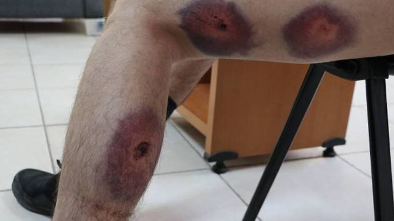Polis HDP’li gence plastik mermi sıktı: Bacaklarında ödem oluştu