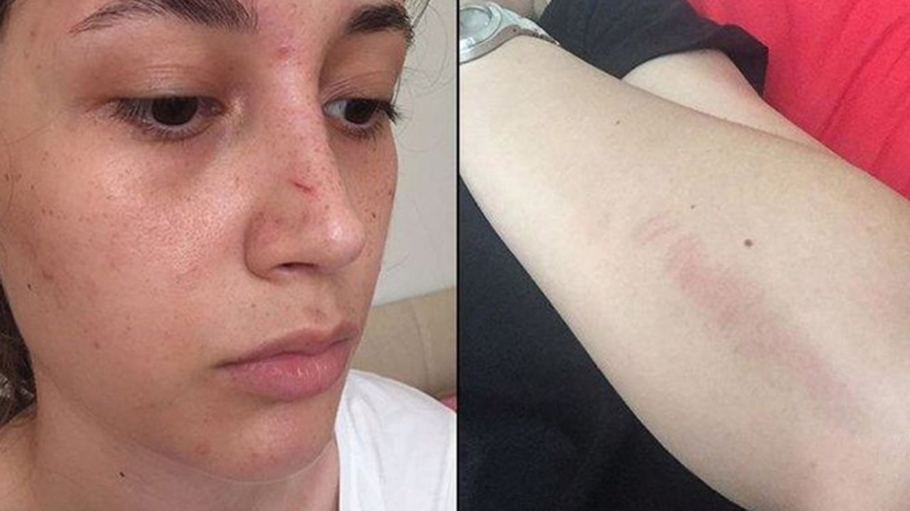 Üniversiteli genç kadın şort giydiği için saldırıya uğradı, saldırgan serbest bırakıldı