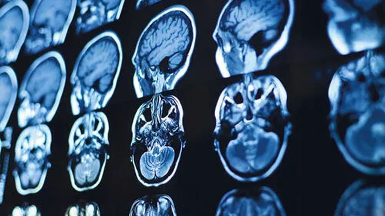 Alzheimer'ı yavaşlattığı gözlenen yeni ilaç onaylandı