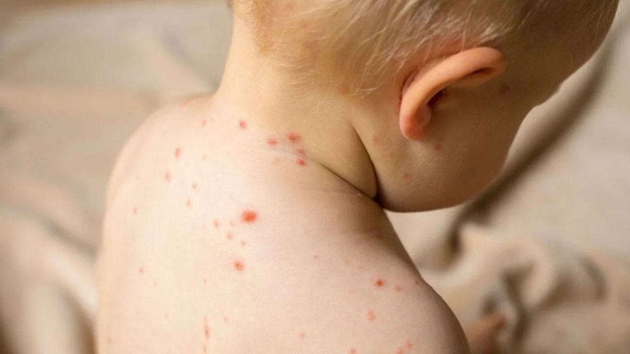 DSÖ'den kızamık salgını uyarısı: 22 milyon çocuk aşı olmadı
