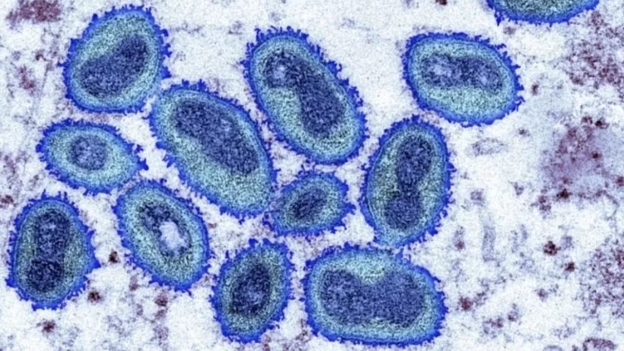 Maymun çiçeği virüsü: İngiltere'de vaka sayısı 20'den 56'ya çıktı