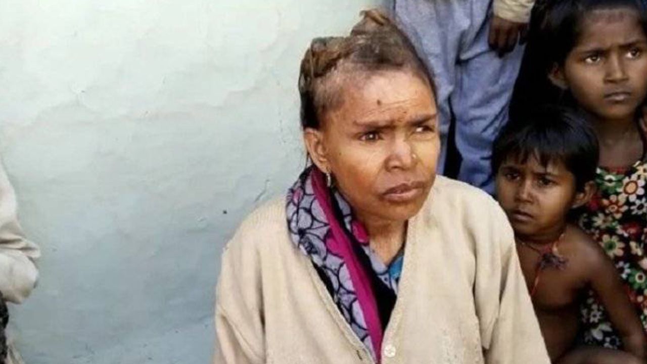 Doktorlar çare bulamadı: Hindistan'da bir kadının kafasında boynuzlar çıkıyor