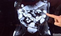 Crohn tedavisinde yeni bir umut ışığı