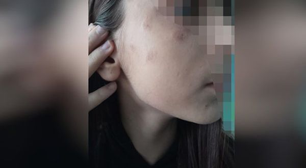 Sevgi Evi'nde kalan 11 yaşındaki çocuğun yüzünde sigara söndürüldü