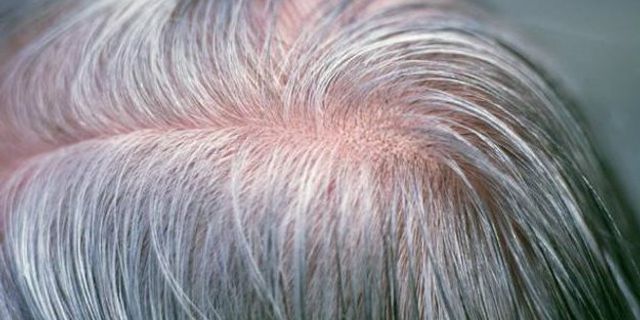 Saçların beyazlaşmasına neden olan gen bulundu