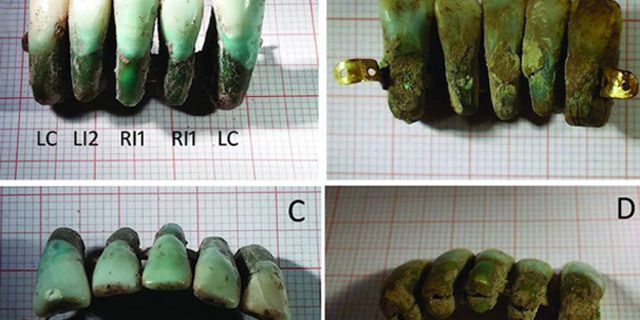 Bilinen en eski diş protezi bulundu