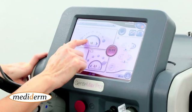 Erkekler İçin Lazer Epilasyon: Hangi Bölgelerde Daha Etkili?