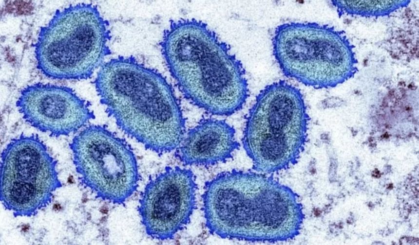 Maymun çiçeği virüsü: İngiltere'de vaka sayısı 20'den 56'ya çıktı